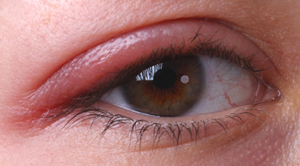 Ocular Rosacea Picture – Blepharitis 