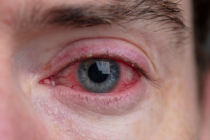 Ocular Rosacea Picture – Severe eye redness