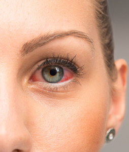Red eyes after eyelash extensions: allergies & infections