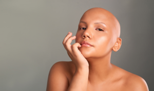 Alopecia universalis hair loss