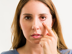 Meibomian Gland Dysfunction – Bloodshot Eyes