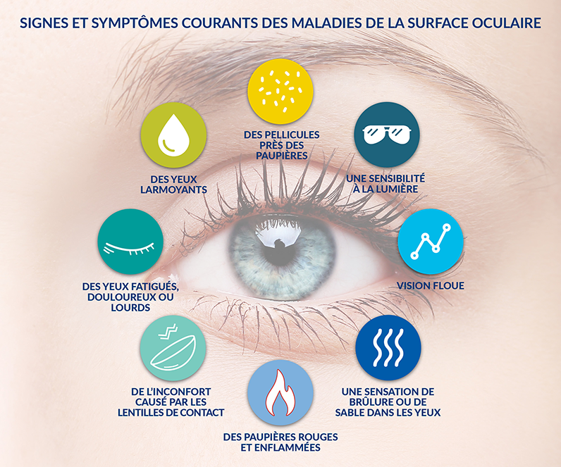Signes et symptômes courants de la sécheresse oculaire