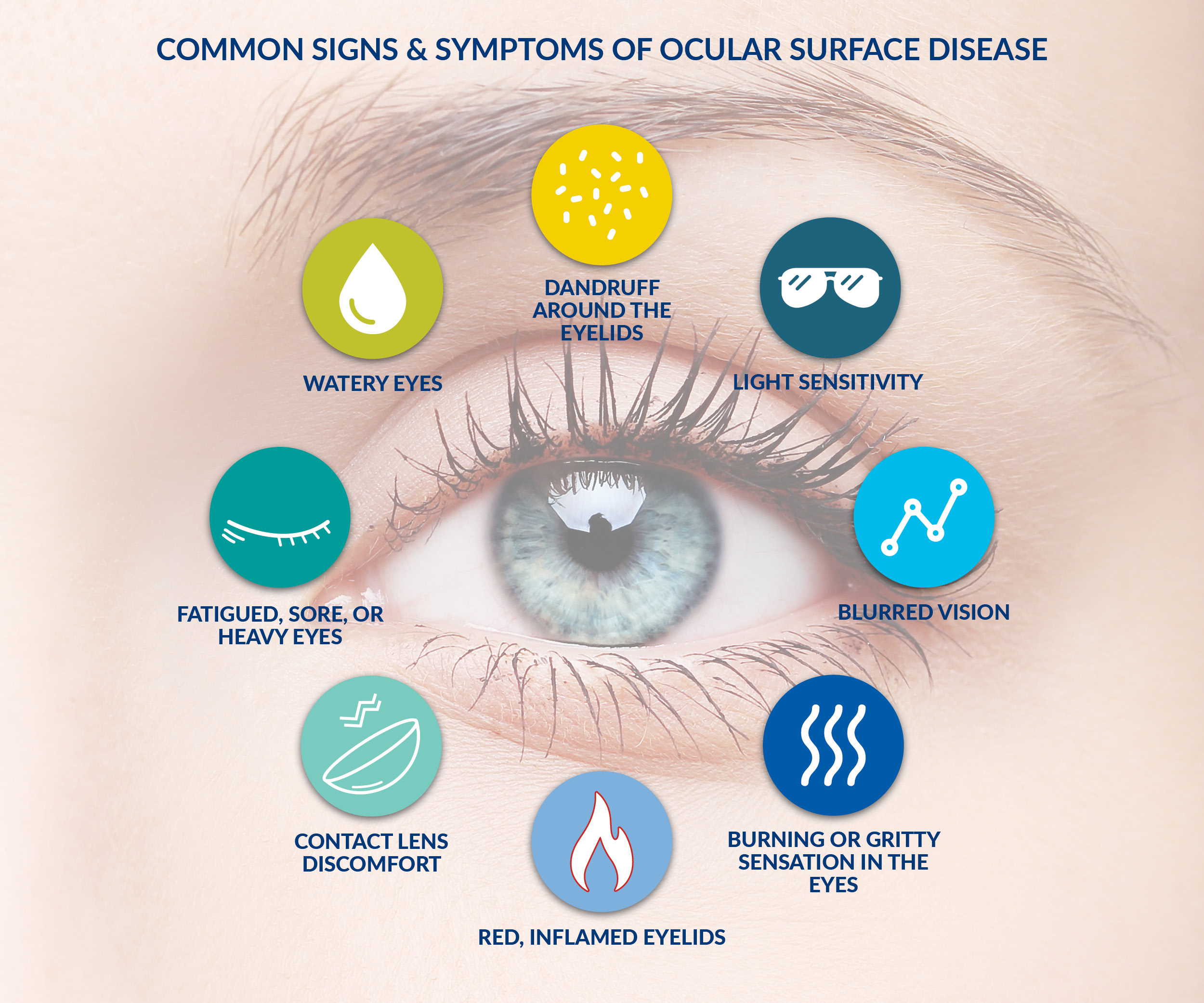 Common signs and symptoms of dry eye syndrome include